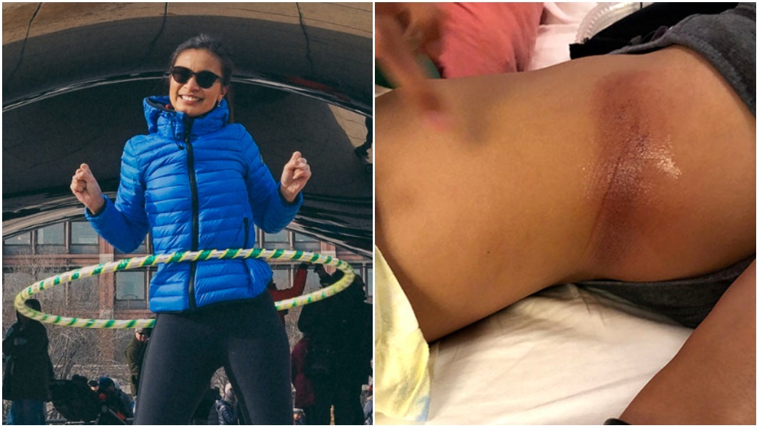 jenny-hooping-and-injury