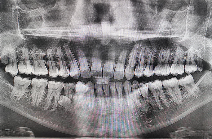 x-ray of the man's teeth